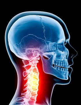 osteoarthritis-neck