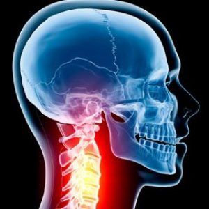 osteoarthritis-neck